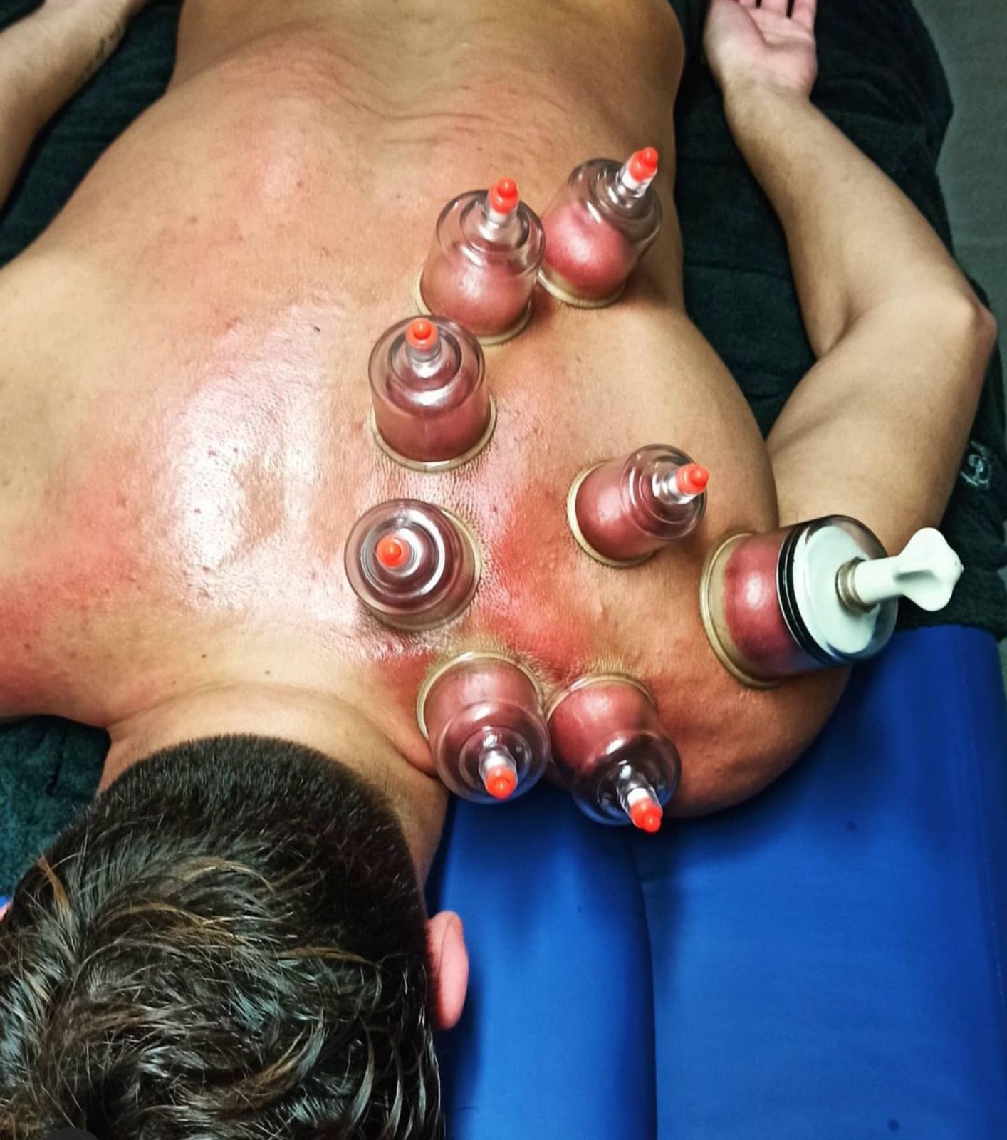 cupping